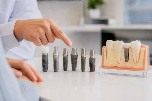 국산 임플란트 종류